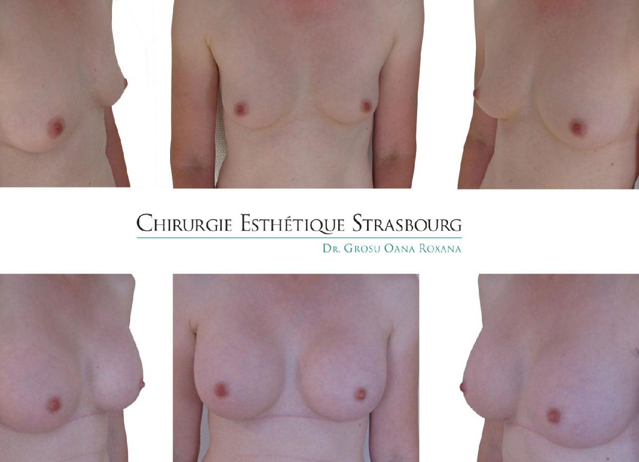 Augmentation des seins Strasbourg