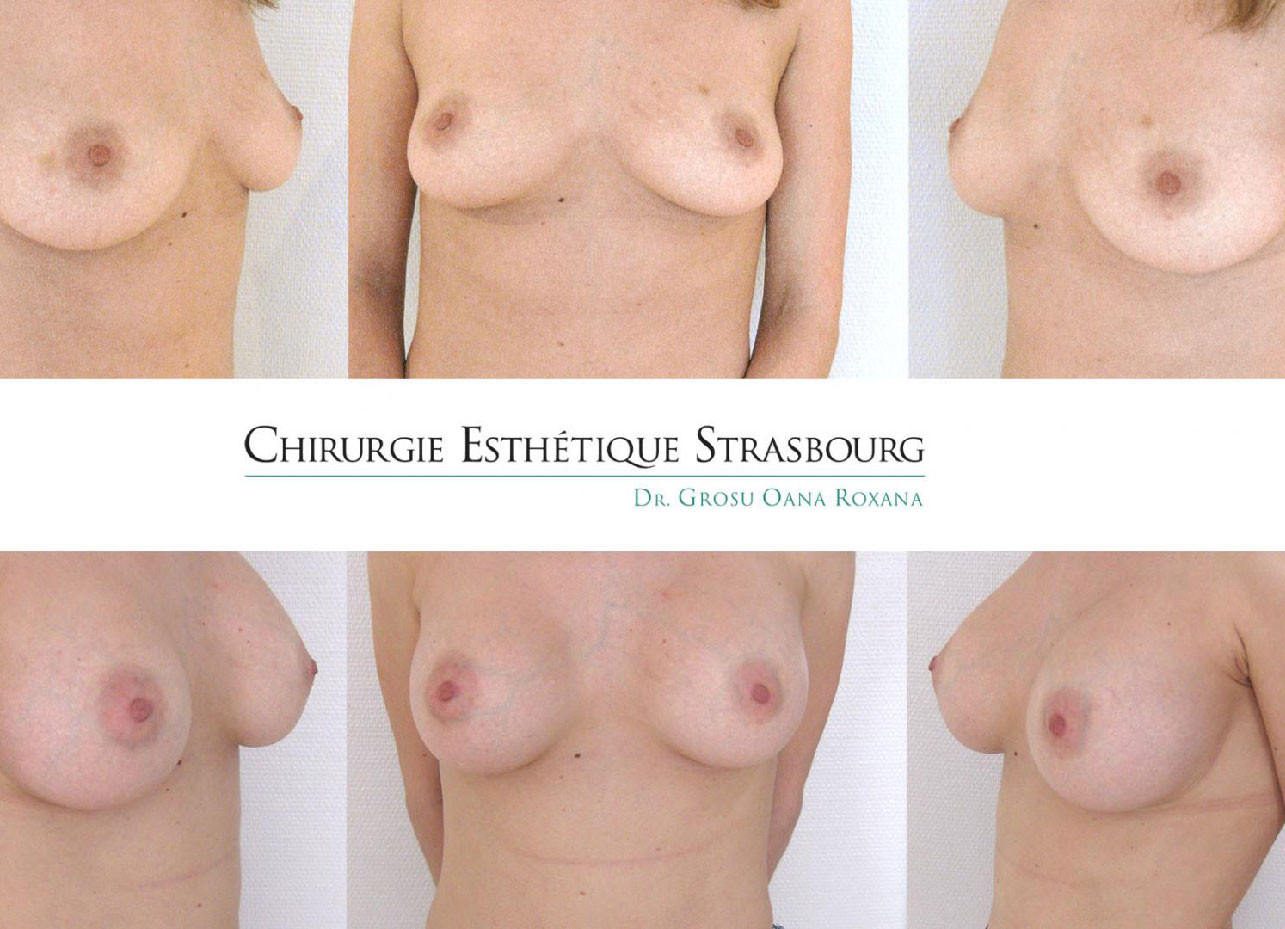 Augmentation mammaire Strasbourg